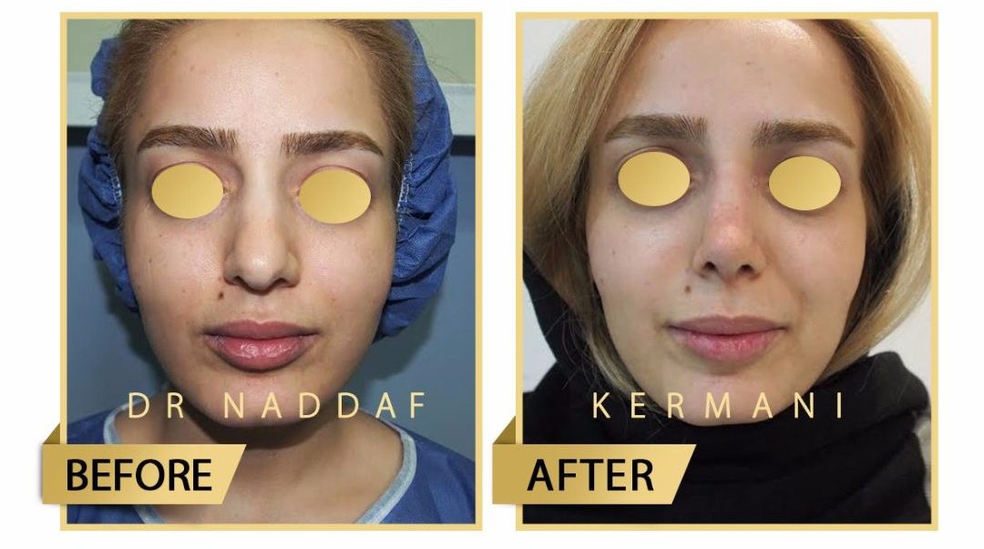 دکتر مجید نداف کرمانی قبل و بعد دکتر مجید نداف کرمانی قبل و بعد