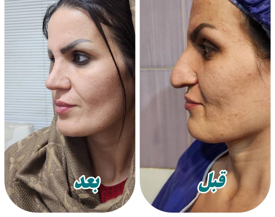 دکتر هاشم شمشادی قبل و بعد دکتر هاشم شمشادی قبل و بعد