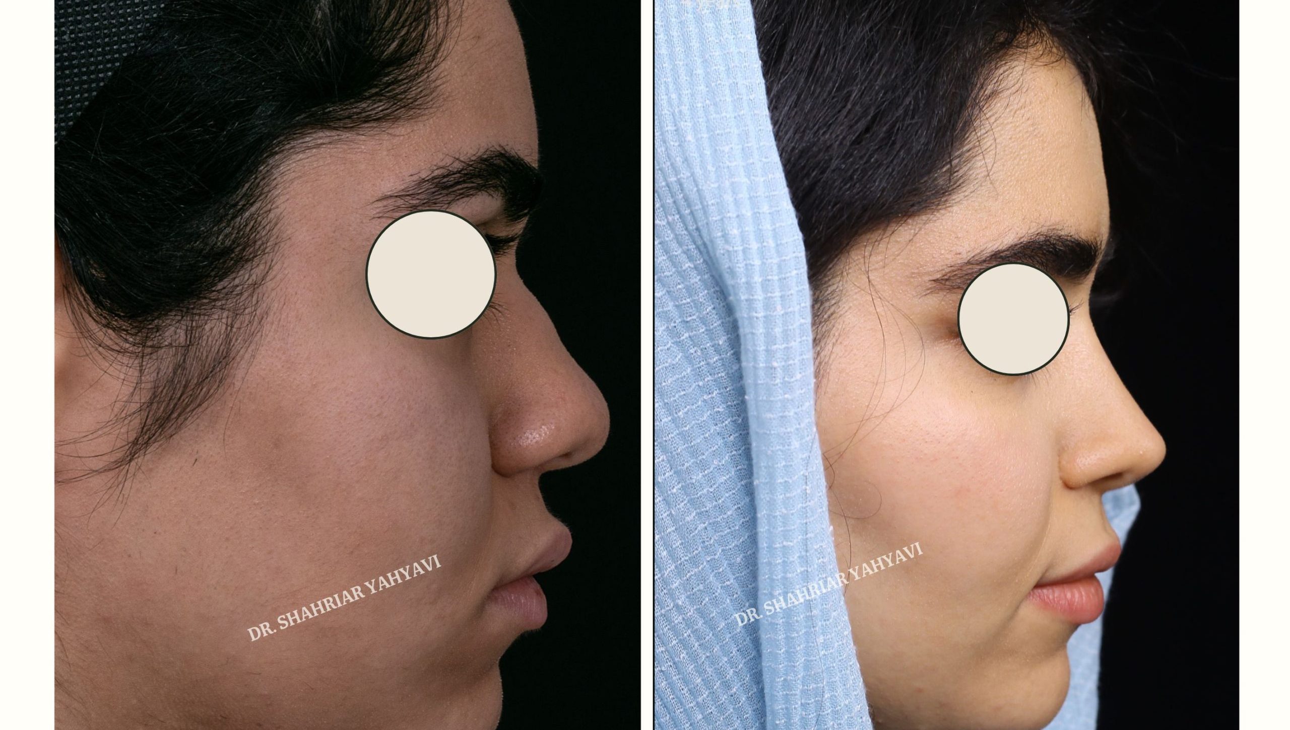 دکتر شهریار یحیوی قبل و بعد دکتر شهریار یحیوی قبل و بعد