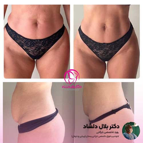 دکتر بلال دلشاد قبل و بعد دکتر بلال دلشاد قبل و بعد