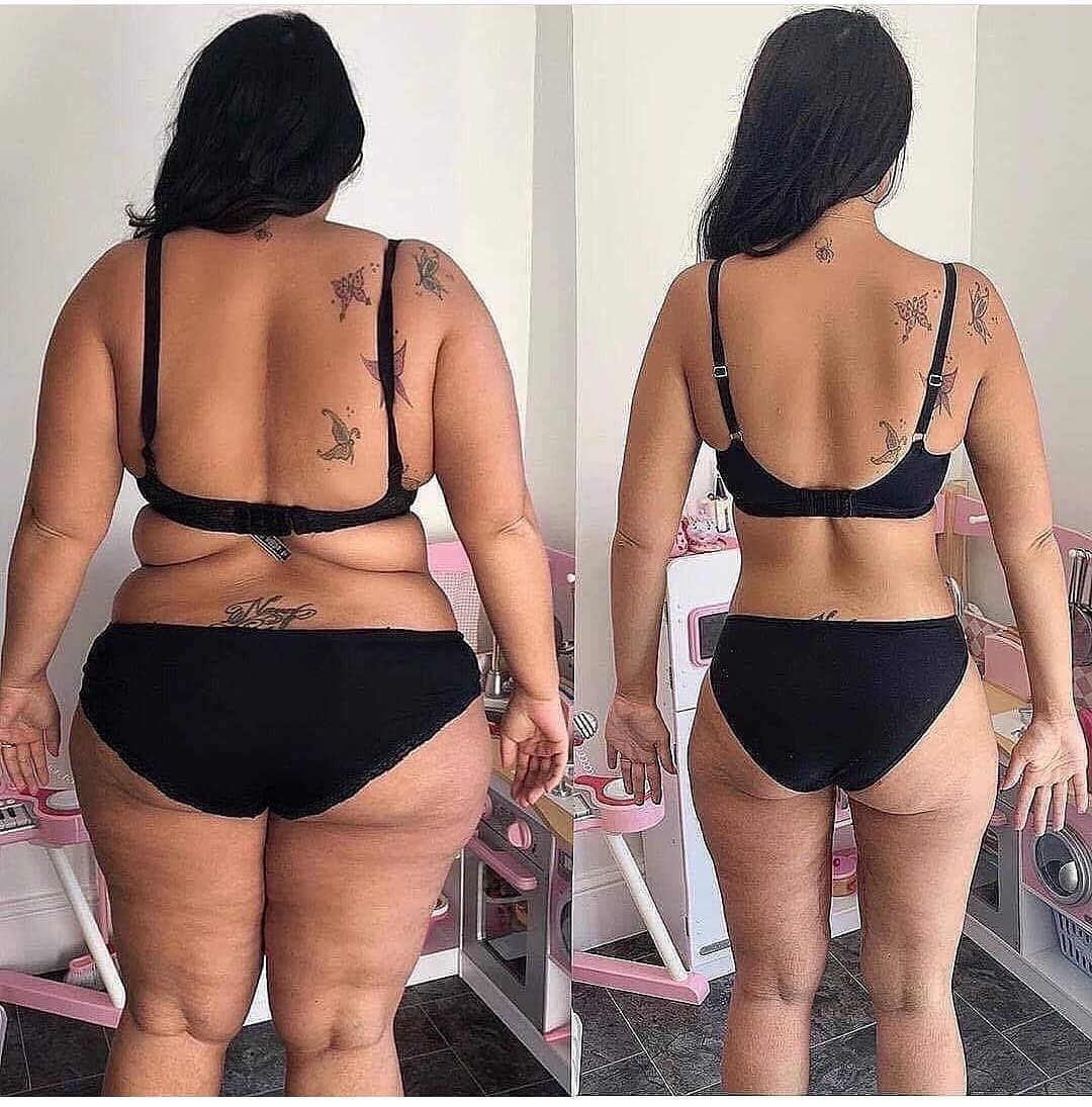 تخلیه چربی باسن