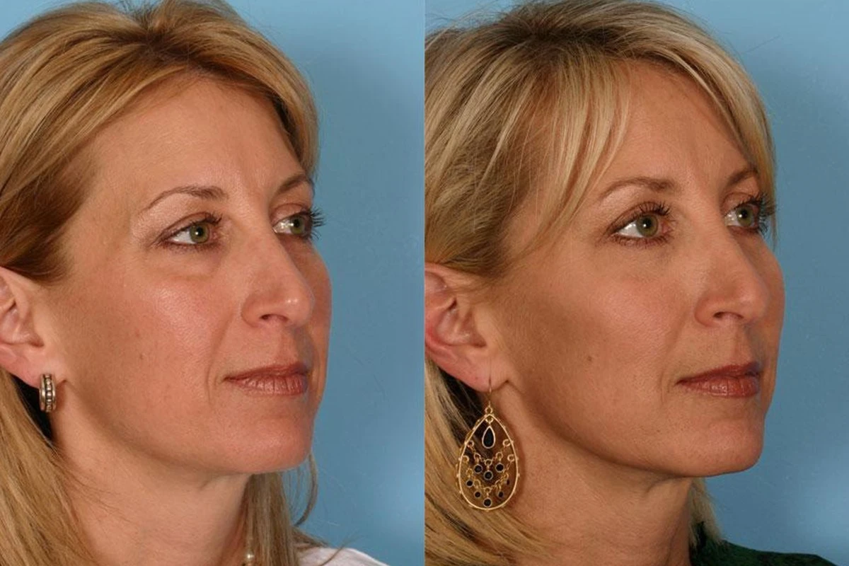 فیلر رفع چروک‌های صورت