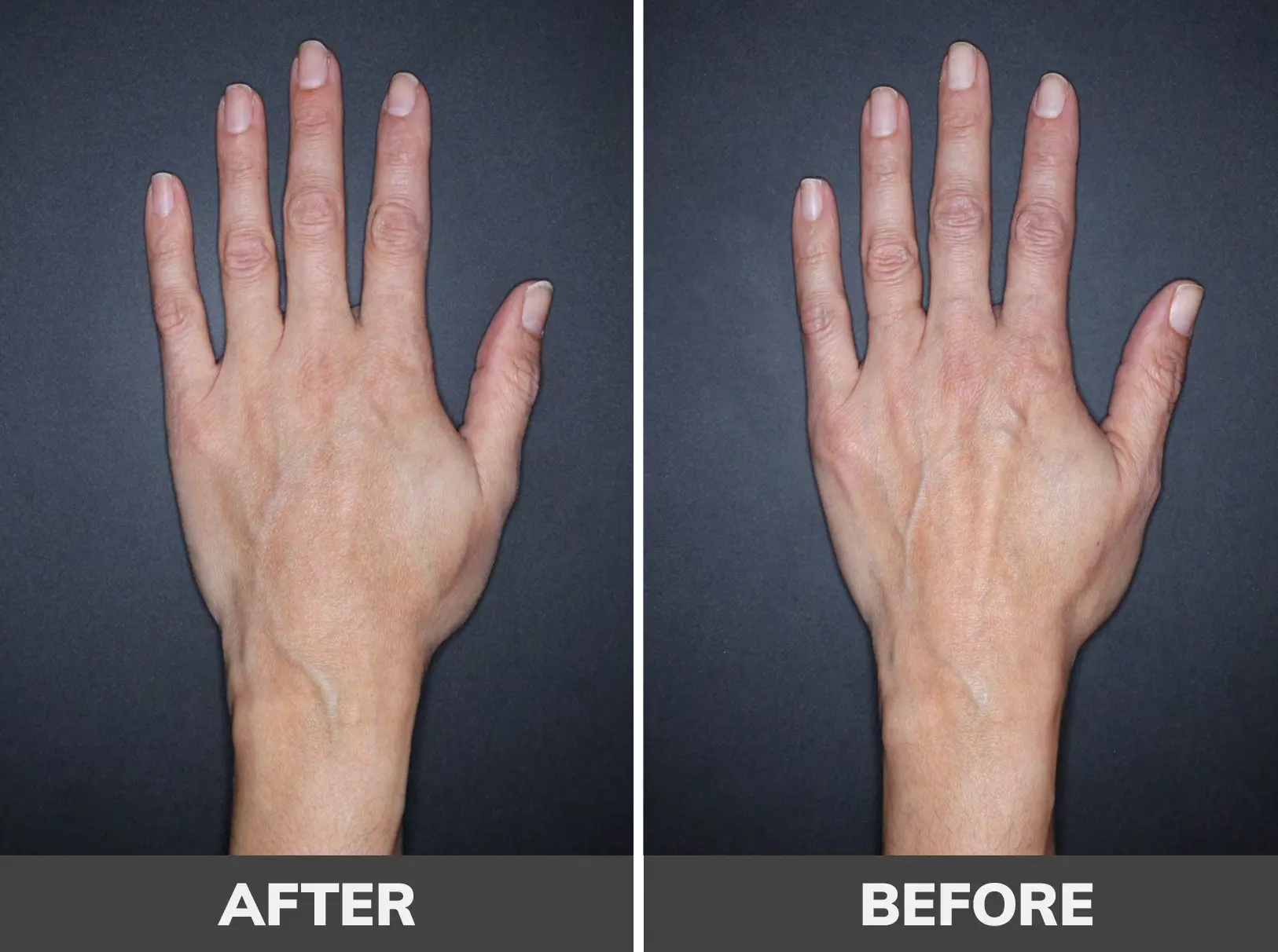 فیلر برای چاقی دست