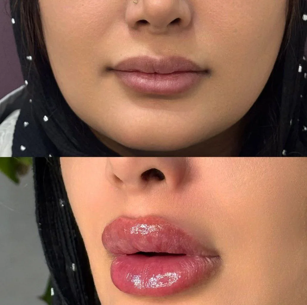 فیلر لب پاپی