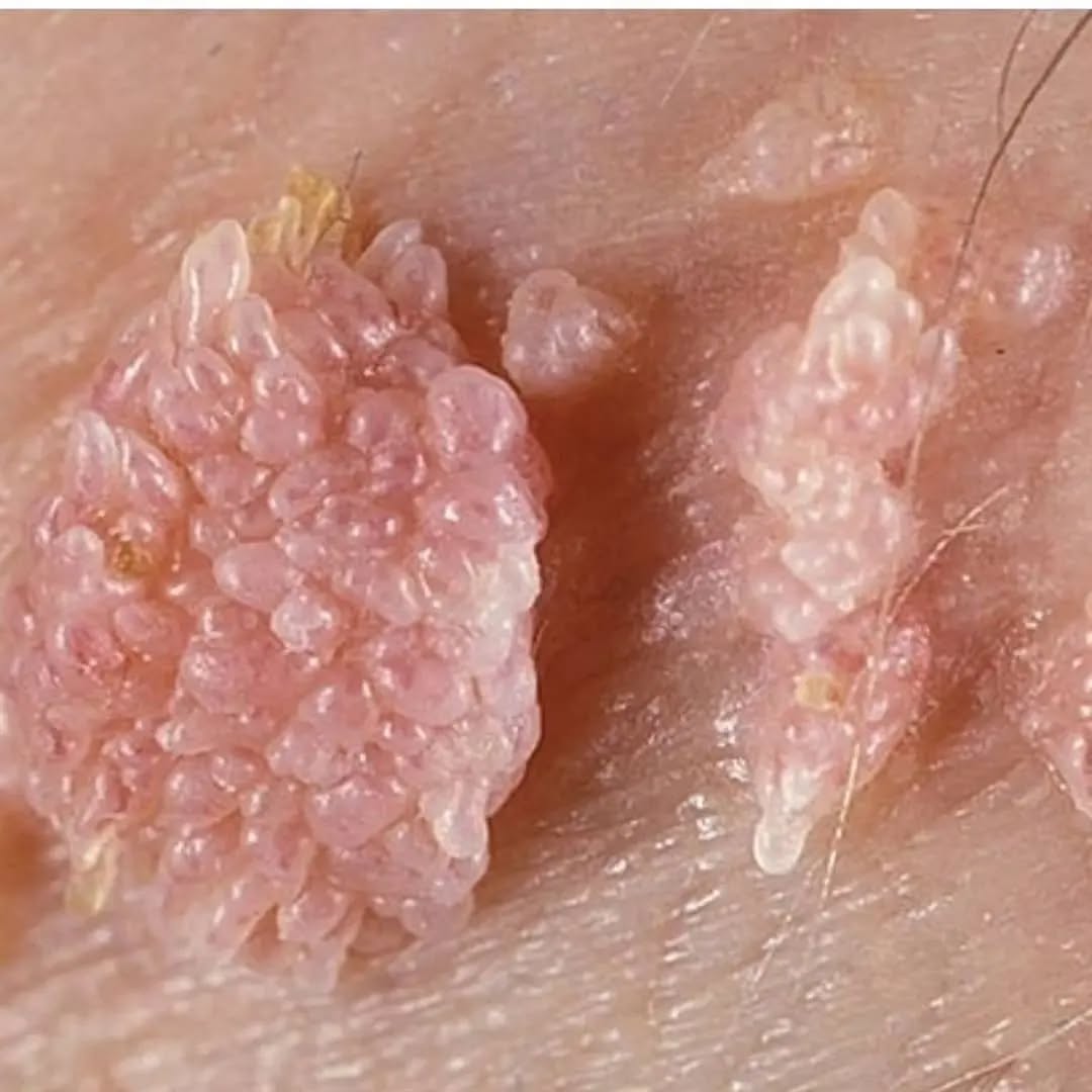 زگیل‌ تناسلی