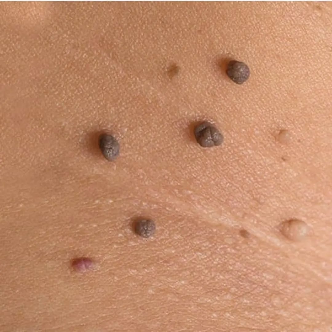 عکس زگیل تناسلی