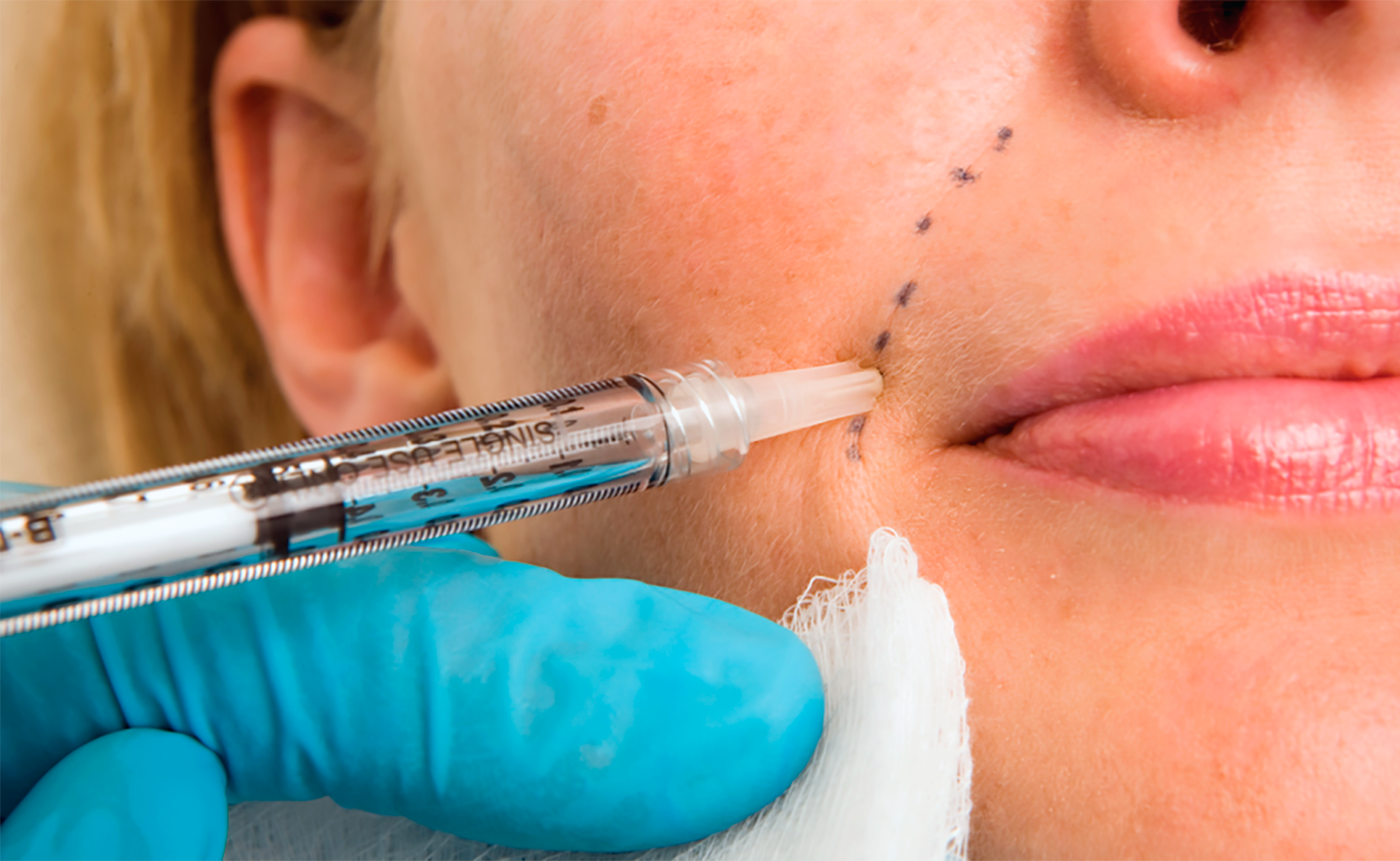 مزایای فیلرها