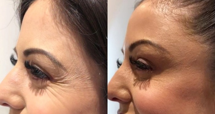 فیلر های مناسب برای چین و چروک های عمیق