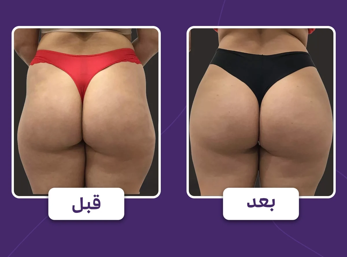 فیلرهای باسن 